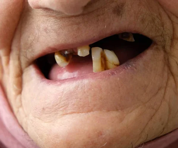 dente